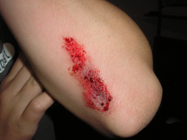 Blessure et réaction inflammatoire